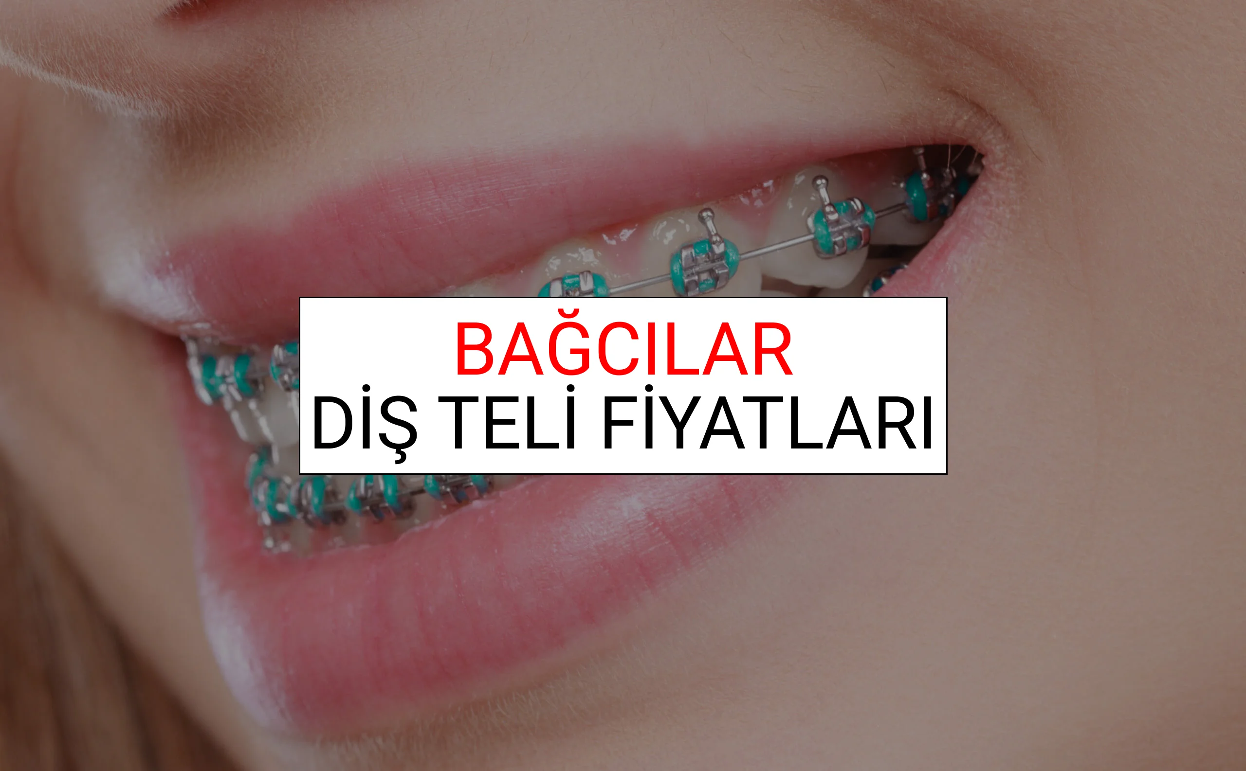 Bağcılar Diş Teli Fiyatları