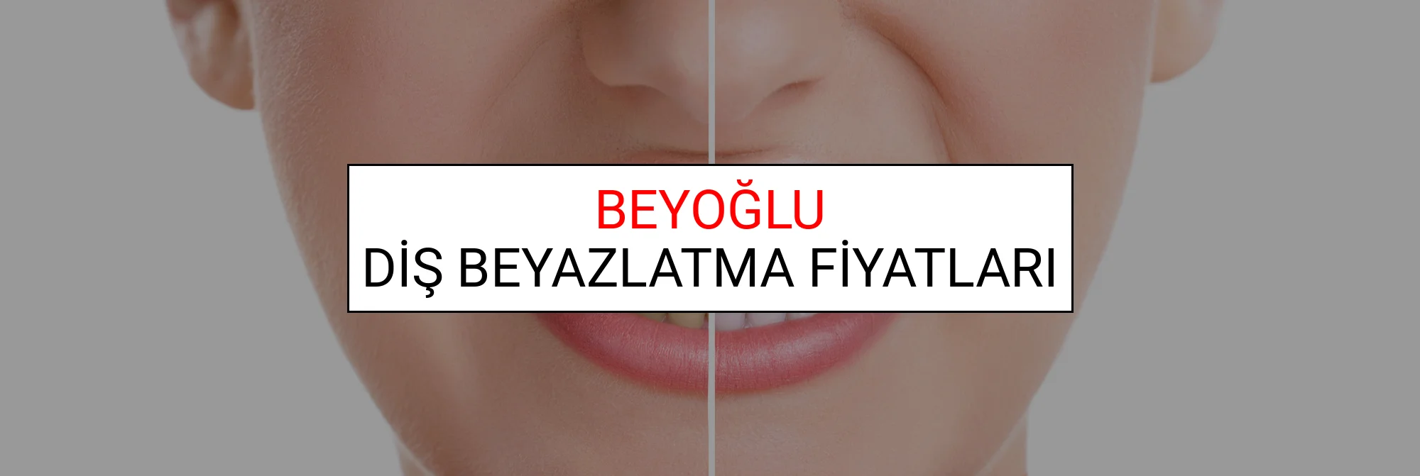 Beyoğlu Diş Beyazlatma Fiyatları
