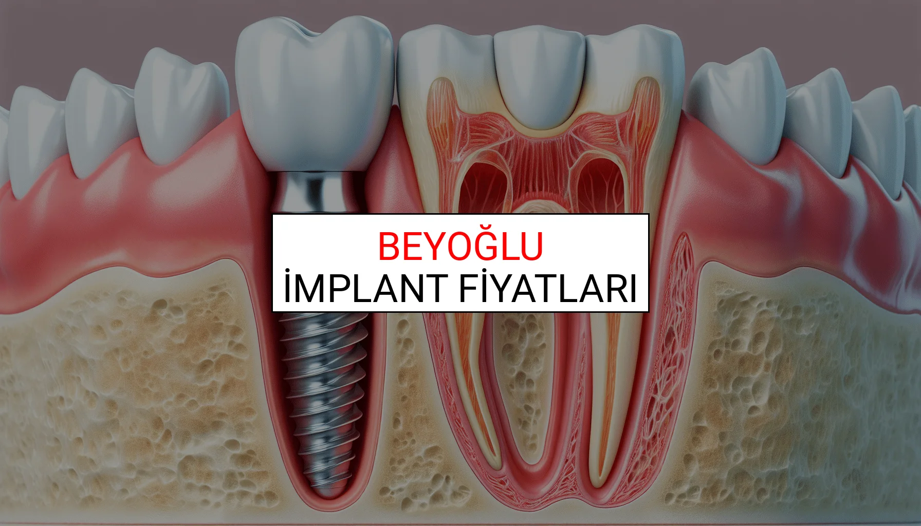 Beyoğlu İmplant Fiyatları