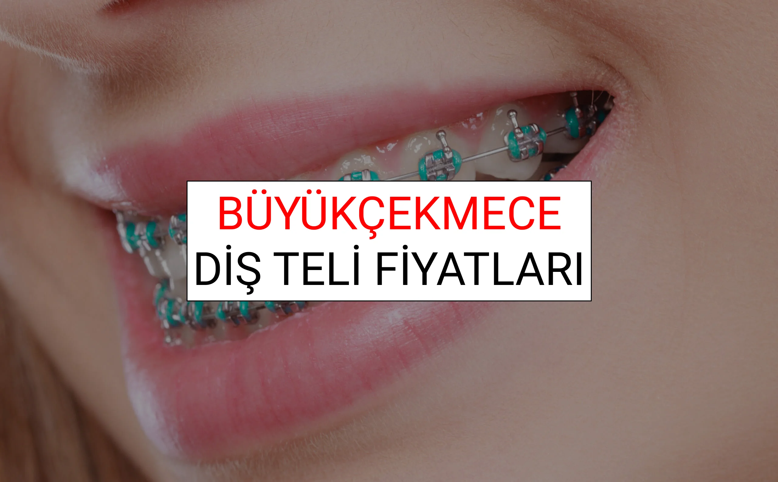 Büyükçekmece Diş Teli Fiyatları