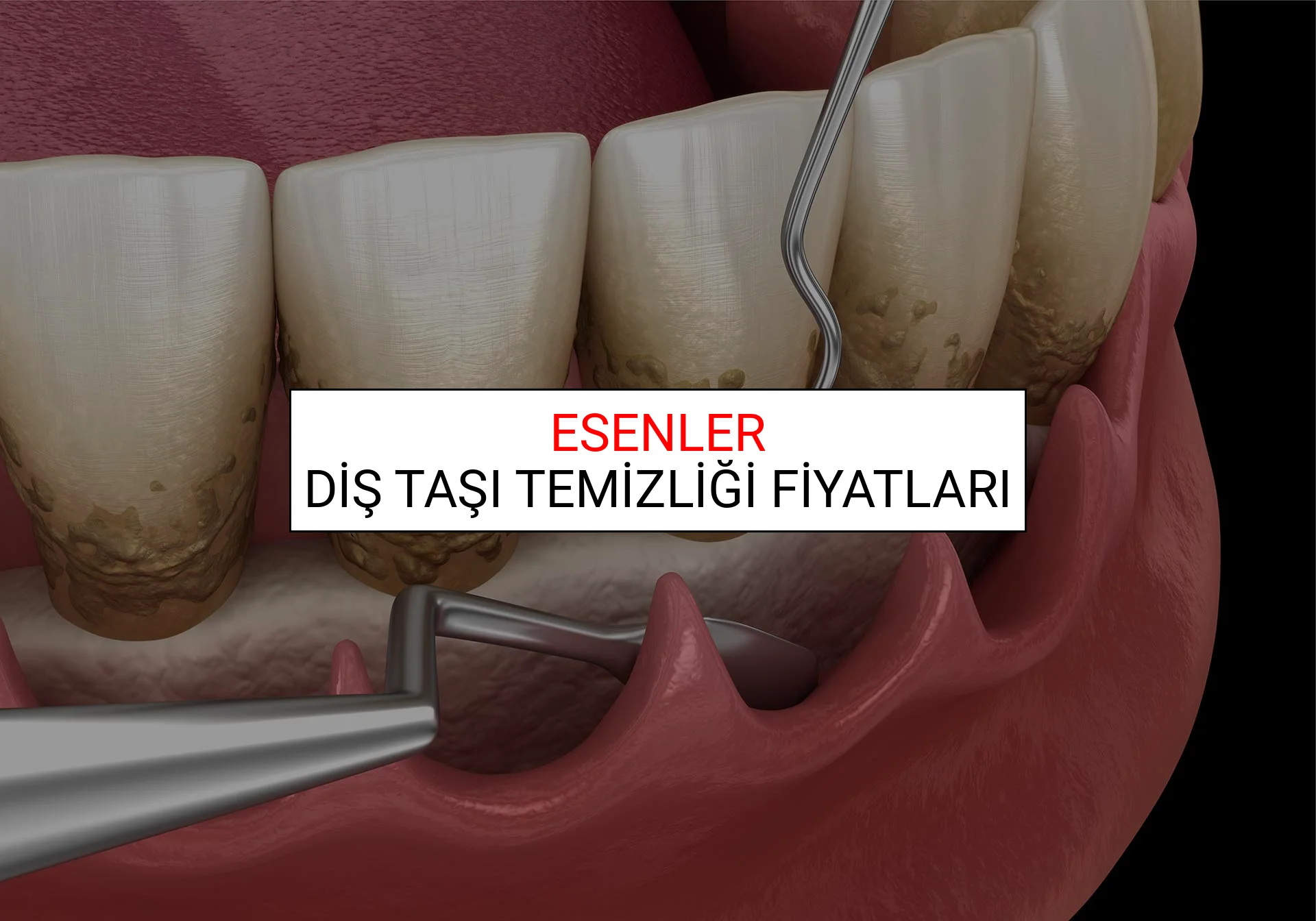 Esenler Diş Taşı Temizliği Fiyatları