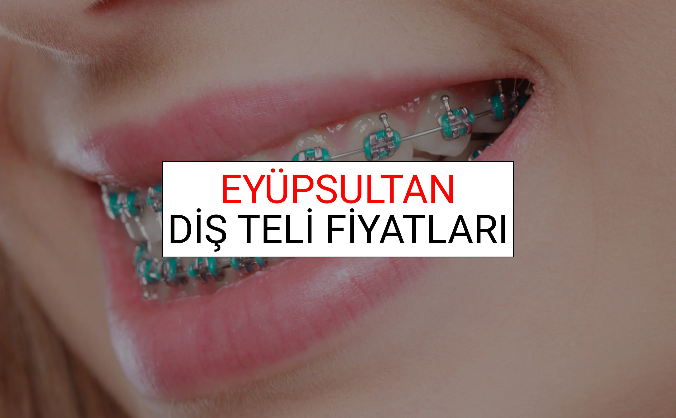 Eyüpsultan Diş Teli Fiyatları