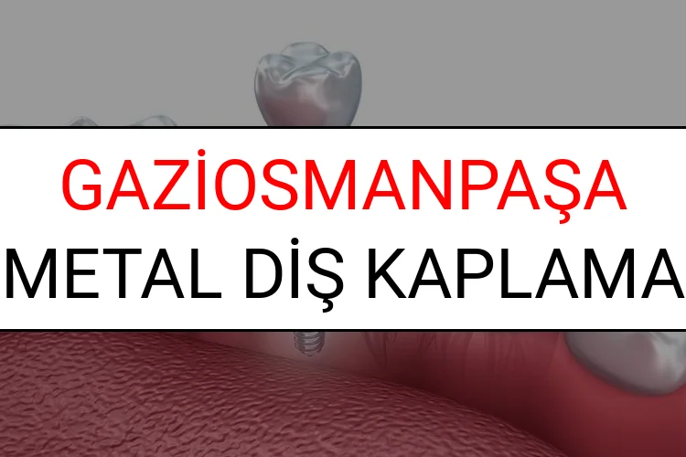 Gaziosmanpaşa Metal Diş Kaplama Fiyatları