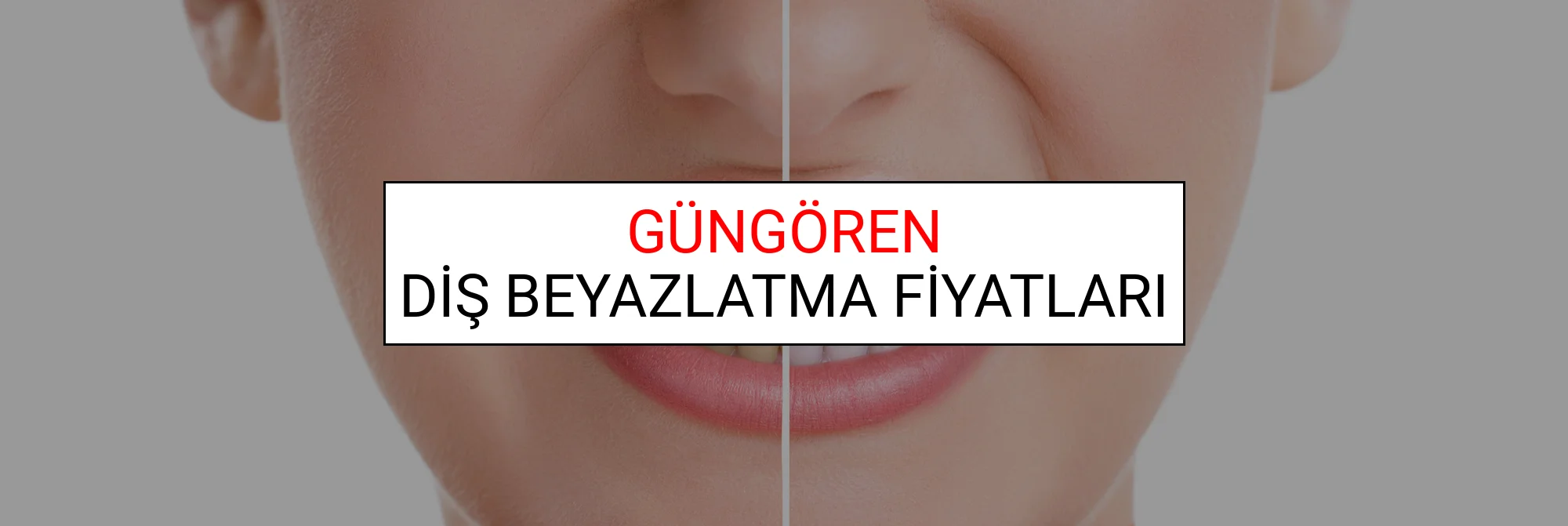 Güngören Diş Beyazlatma Fiyatları