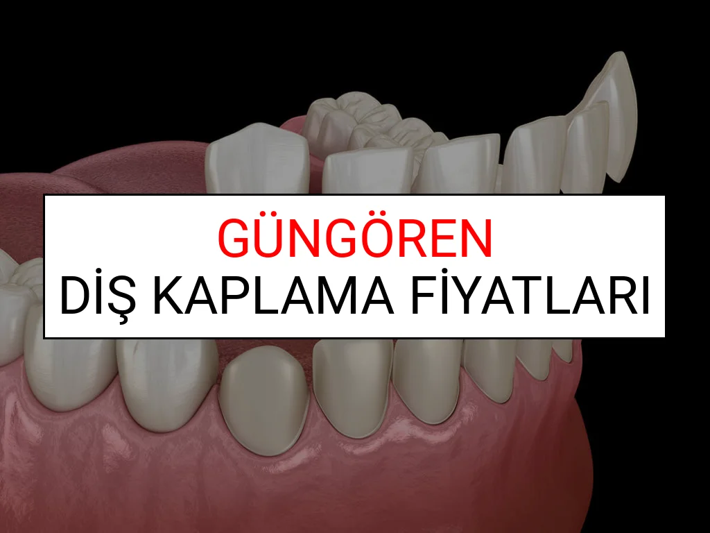 Güngören Diş Kaplama Fiyatları
