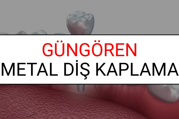Güngören Metal Diş Kaplama Fiyatları