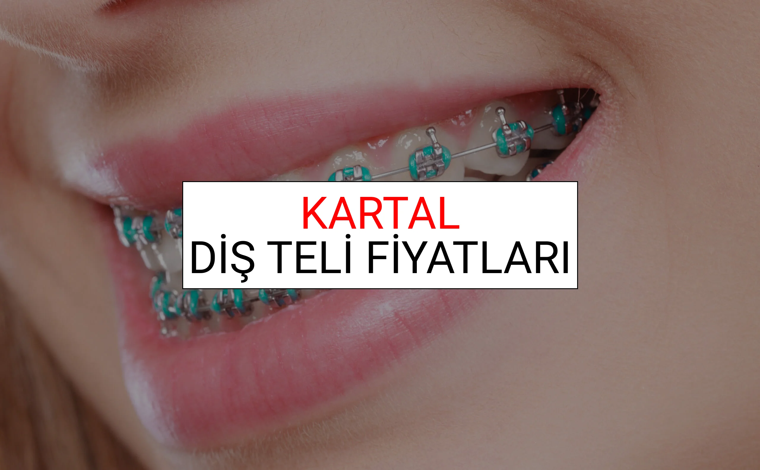 Kartal Diş Teli Fiyatları