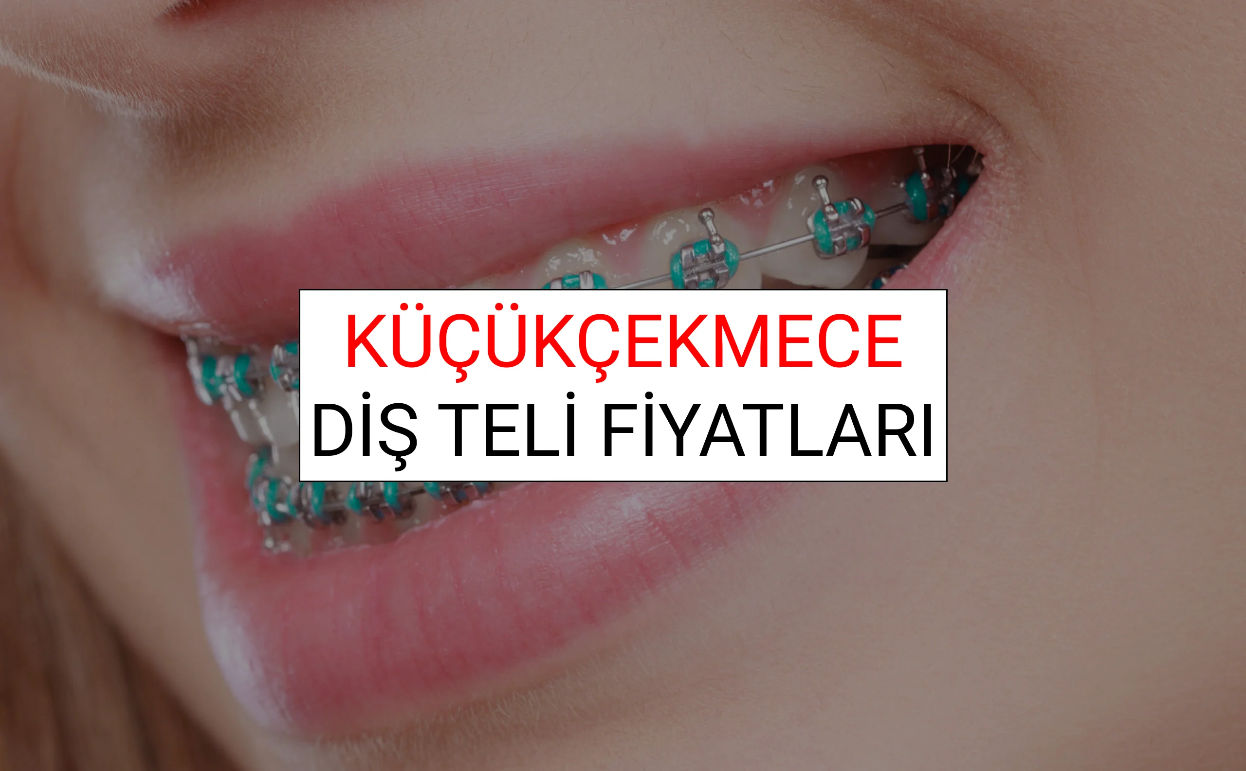 Küçükçekmece Diş Teli Fiyatları