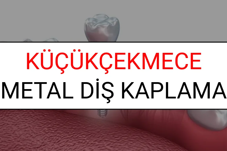 Küçükçekmece Metal Diş Kaplama Fiyatları