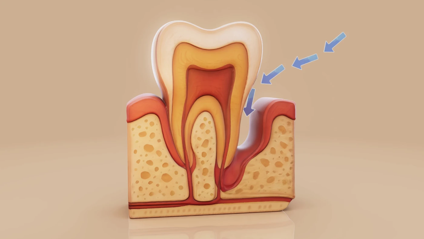 Sinus Lifting (Sinüs Kaldırma)