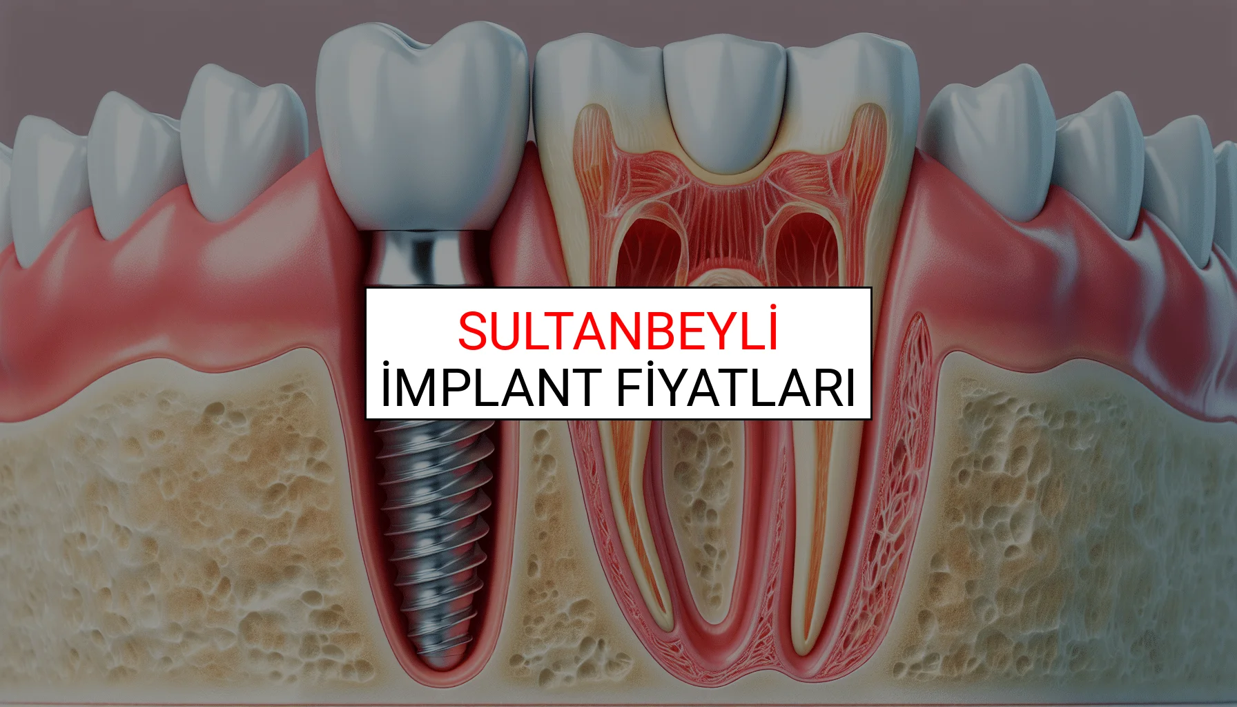 Sultanbeyli İmplant Fiyatları