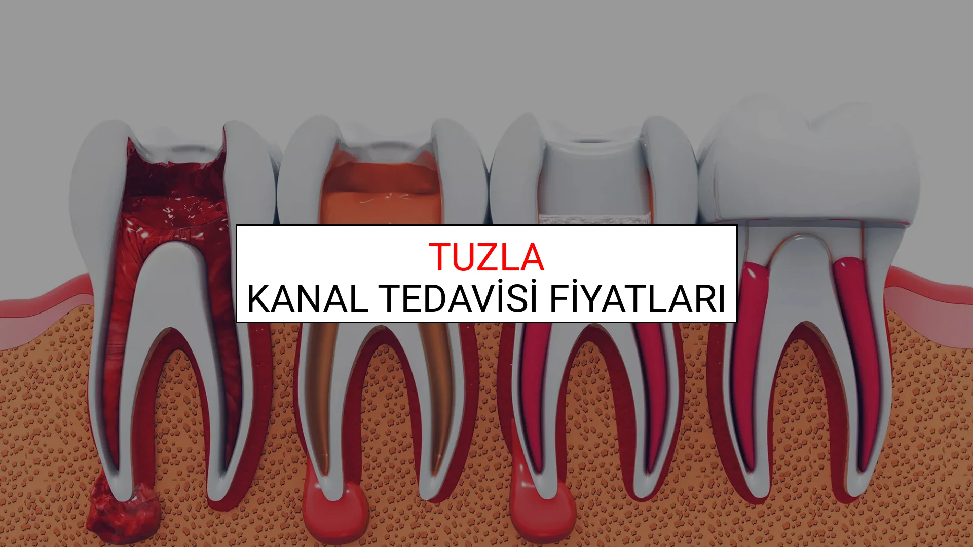 Tuzla Kanal Tedavisi Fiyatları