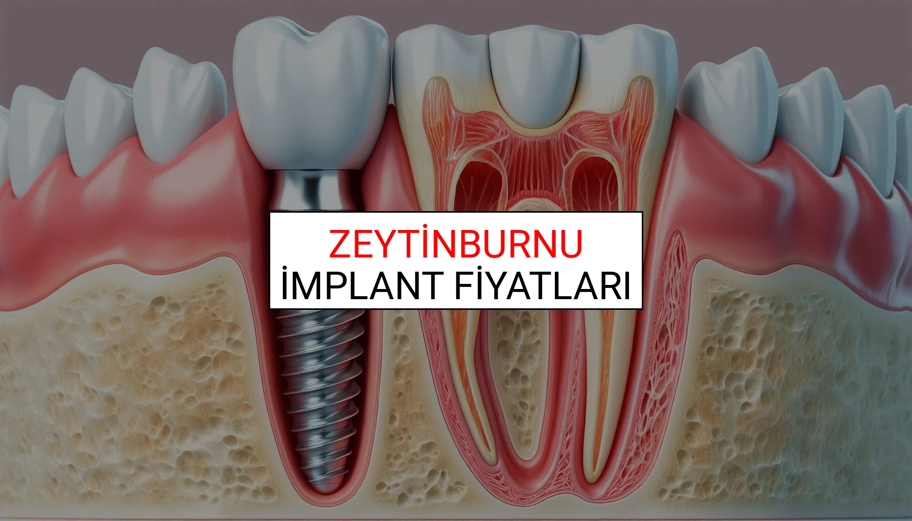 Zeytinburnu İmplant Fiyatları